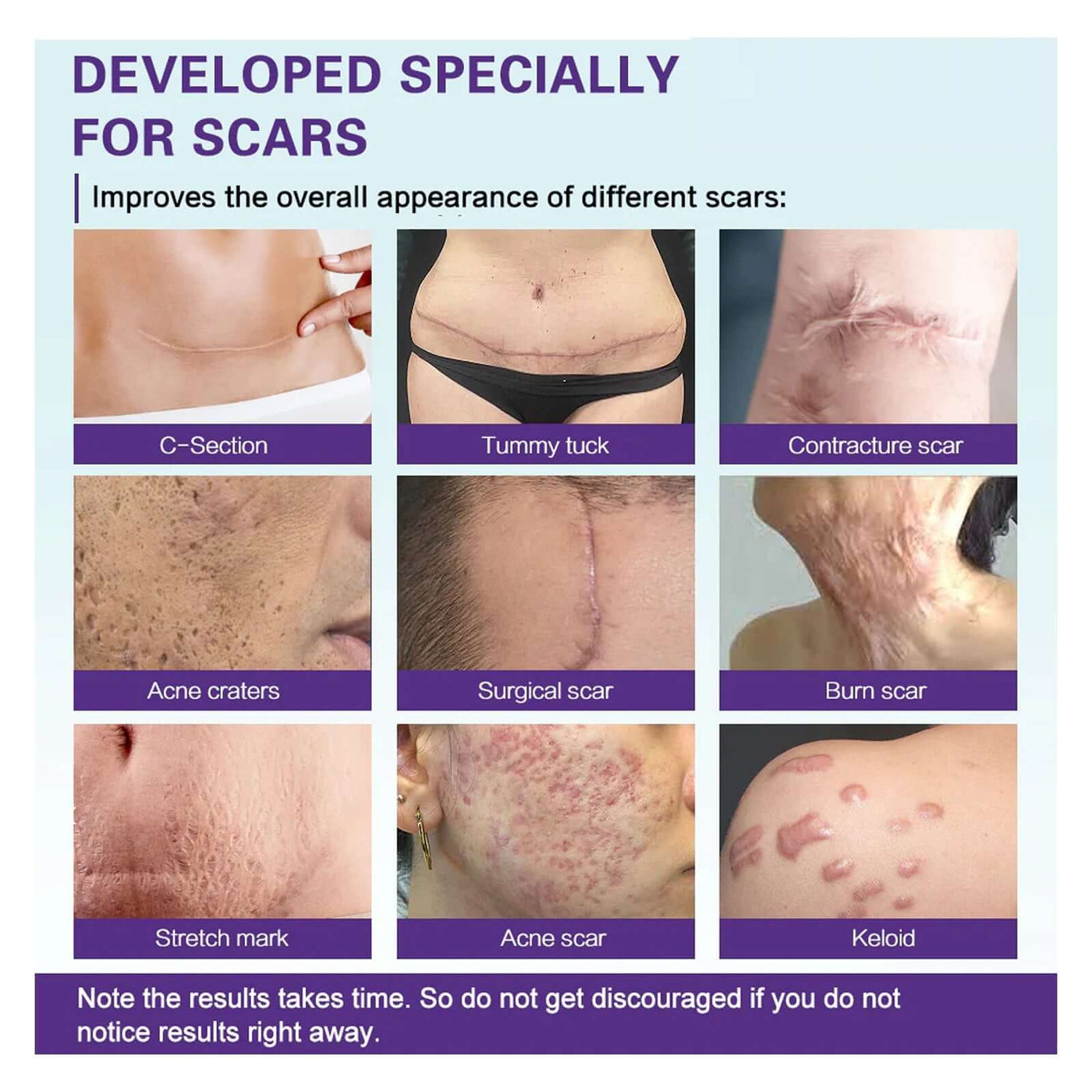 High-quality Silicone Scar Gel, Lighten Acne Mark Scar Repair Skin Smoothing Care Cream eprolo