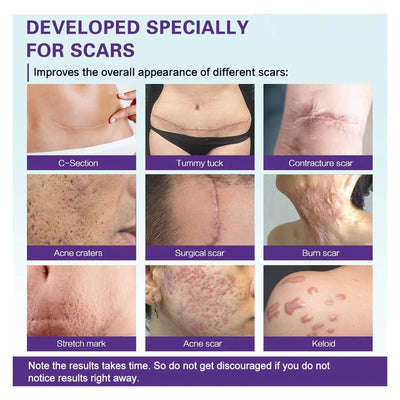 High-quality Silicone Scar Gel, Lighten Acne Mark Scar Repair Skin Smoothing Care Cream eprolo