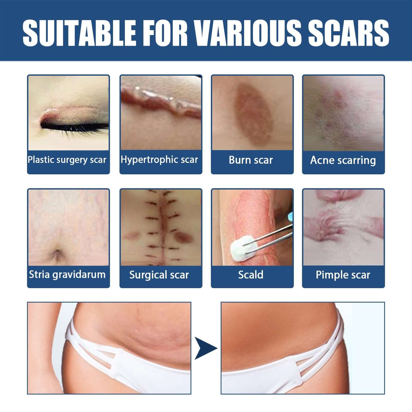 Scar Balm, Surgery Scar Repair Cold Compress Scar Skin Scar Gel Balm eprolo