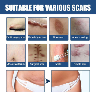 Scar Balm, Surgery Scar Repair Cold Compress Scar Skin Scar Gel Balm eprolo