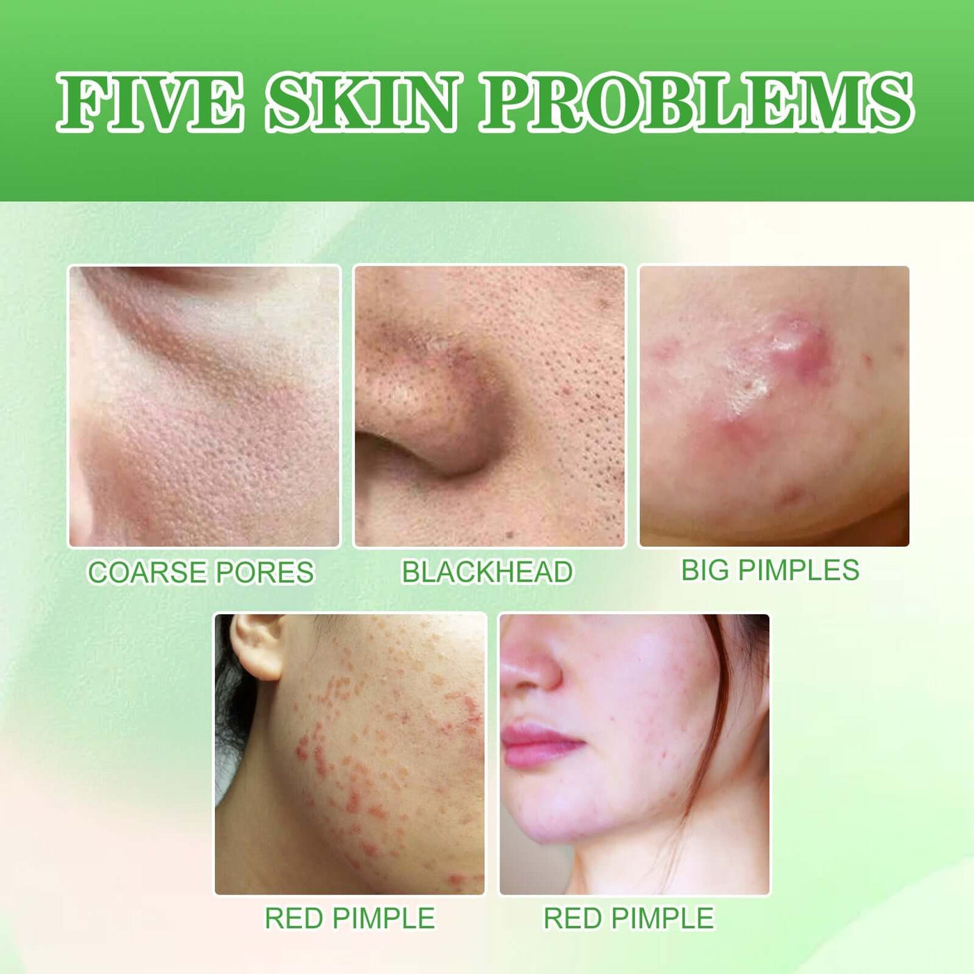 Salicylic Acid Cleaning Gasket, Moisturizing Oil Control Removing Blackheads And Acne Closing Gentle Cleansing Acne Muscle Repair eprolo