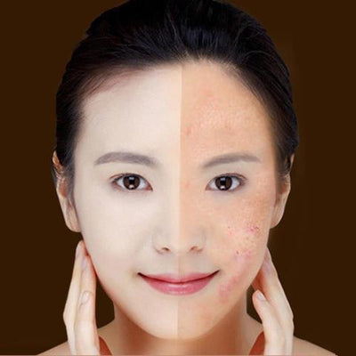 Before and after image showing skin improvement with a blue light therapy acne laser pen treatment.