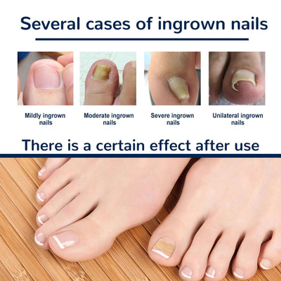 Nail Correction Patch, Nail Insert Correction And Repair Toe Manicure Nail Patch eprolo