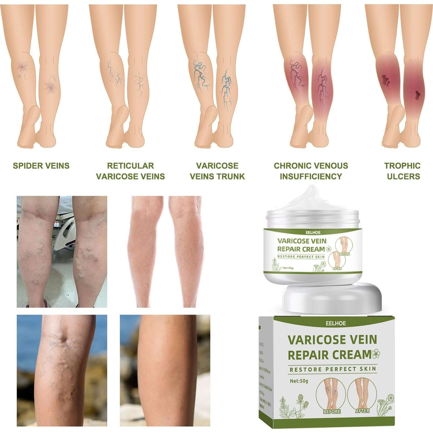 Leg Repair Cream Relieves Leg Discomfort Massage Leg Repair Cream For Raised Veins eprolo