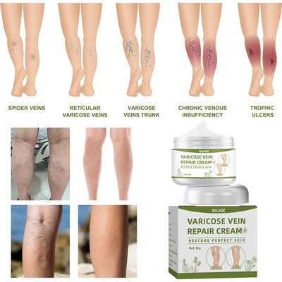 Leg Repair Cream Relieves Leg Discomfort Massage Leg Repair Cream For Raised Veins eprolo