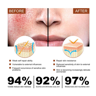 Erythematous Repair Essence, Repair Skin Lighten Facial Erythematous Moisturizing Essential Oil eprolo
