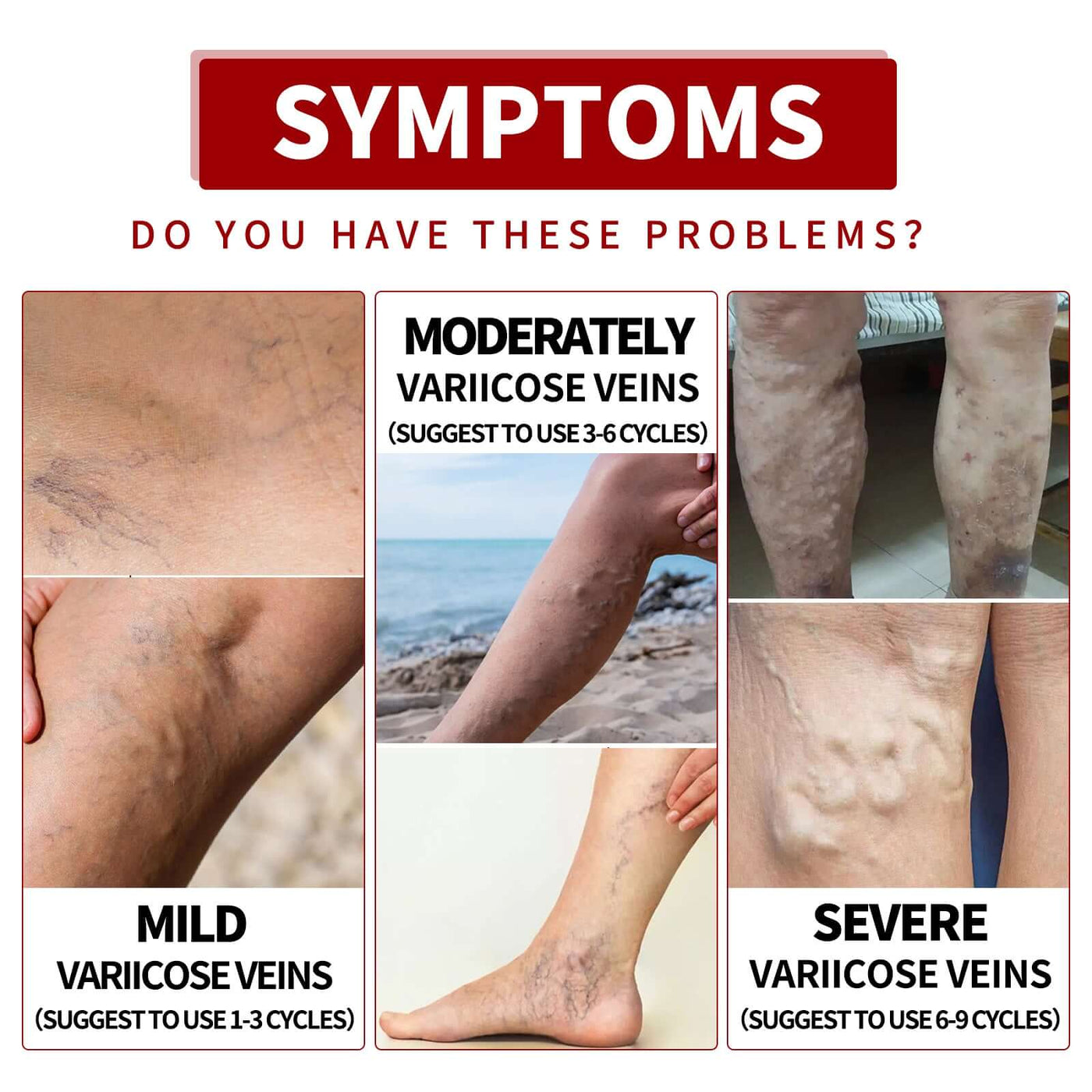 Venous Massage Varicose Cream, Relieves Bulging Leg Blood Vessels And Swollen Leg Earthworm Venous Massage Cream eprolo