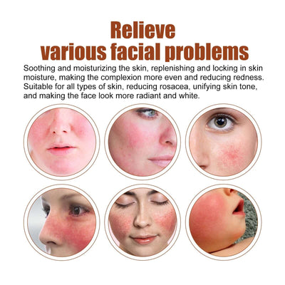 Erythematous Repair Essence, Repair Skin Lighten Facial Erythematous Moisturizing Essential Oil eprolo