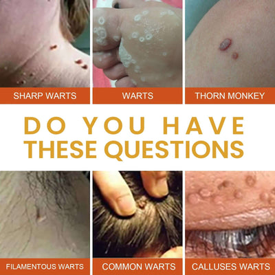 Anti-wart Essence, Anti Warts Fade Moles Corns Smoothing Skin Care Essence eprolo