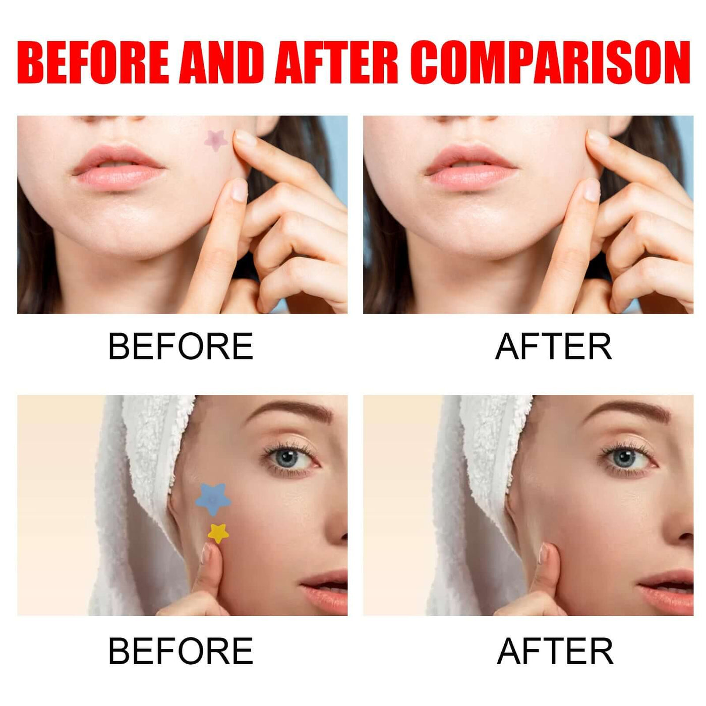 Hydrocolloid pimple patches for face in cute star shape