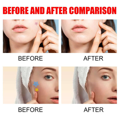 Hydrocolloid pimple patches for face in cute star shape